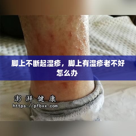 腳上不斷起濕疹，腳上有濕疹老不好怎么辦 