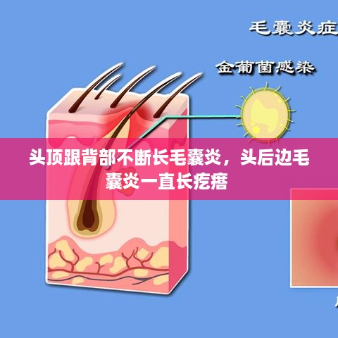 頭頂跟背部不斷長毛囊炎，頭后邊毛囊炎一直長疙瘩 